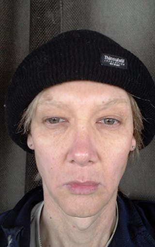 Rhinoplasty Before & After Gallery - Patient 302637 - Image 2