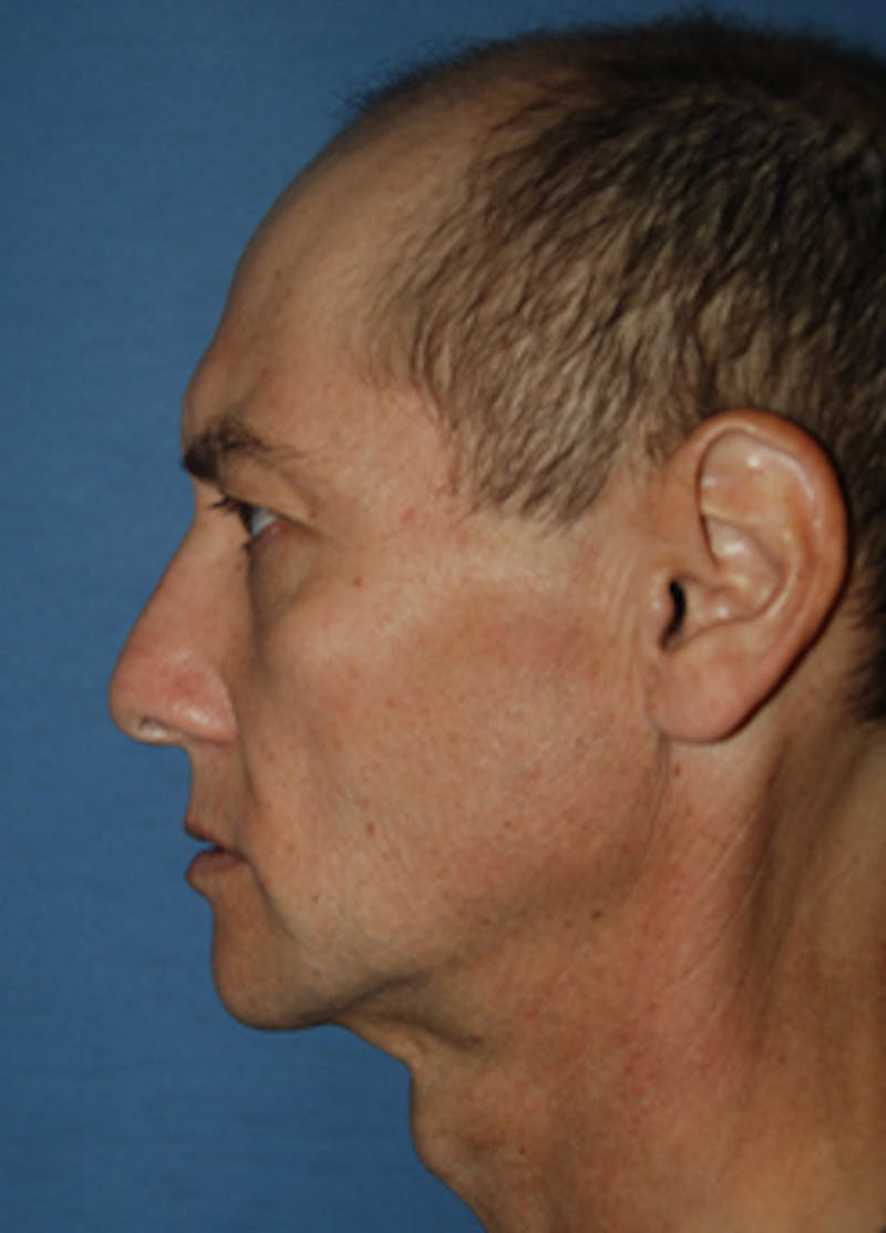 Transgender Surgery Before & After Gallery - Patient 296677 - Image 1