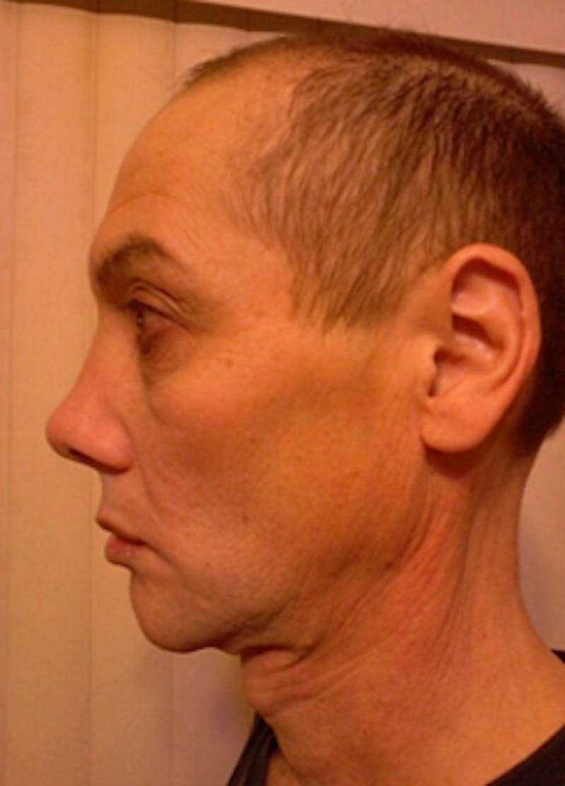 Transgender Surgery Before & After Gallery - Patient 296677 - Image 2