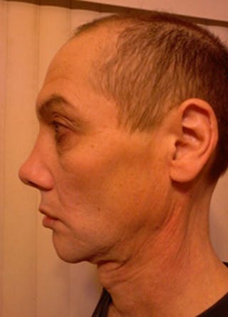 Rhinoplasty Before & After Gallery - Patient 302637 - Image 4