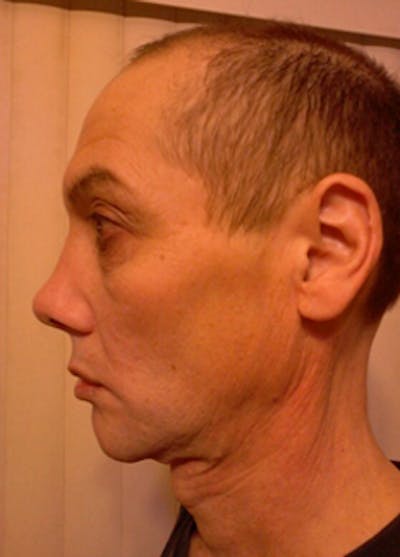 Transgender Surgery Before & After Gallery - Patient 296677 - Image 2