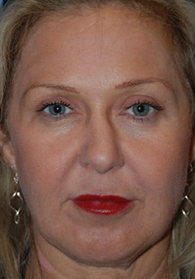 Rhinoplasty Before & After Gallery - Patient 356921 - Image 1