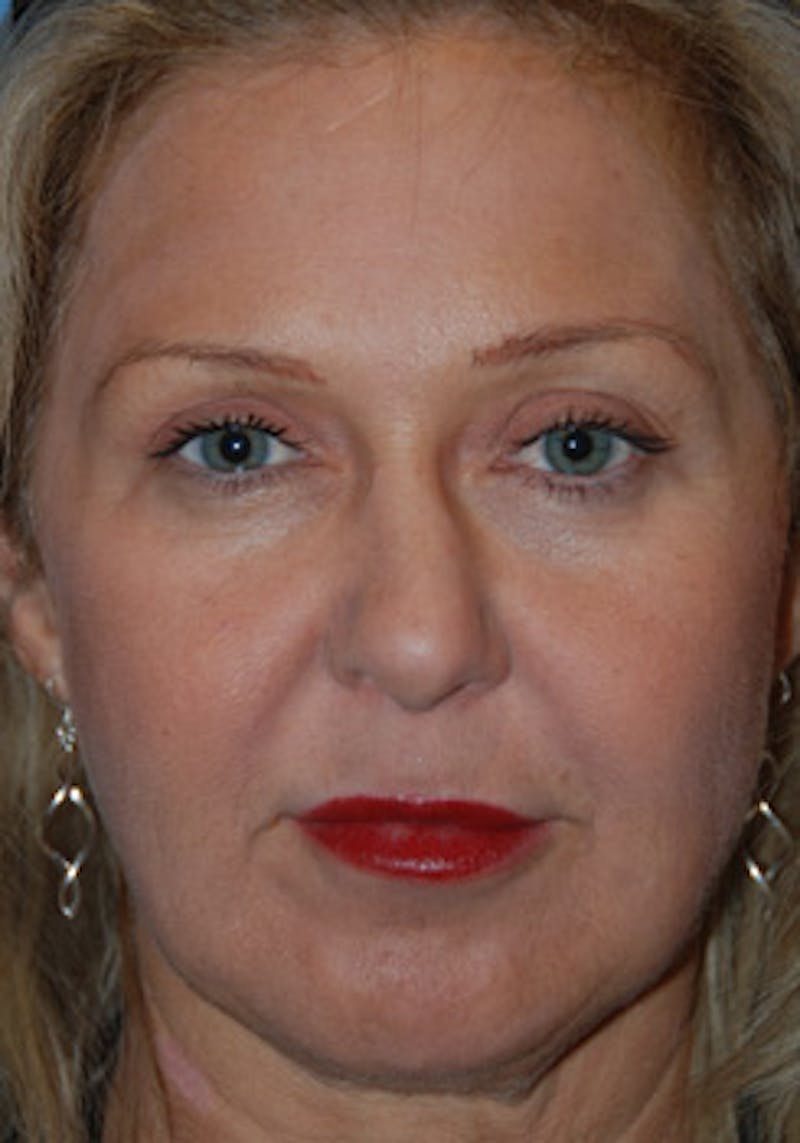 Rhinoplasty Before & After Gallery - Patient 356921 - Image 1