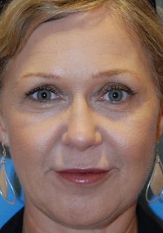 Rhinoplasty Before & After Gallery - Patient 356921 - Image 2