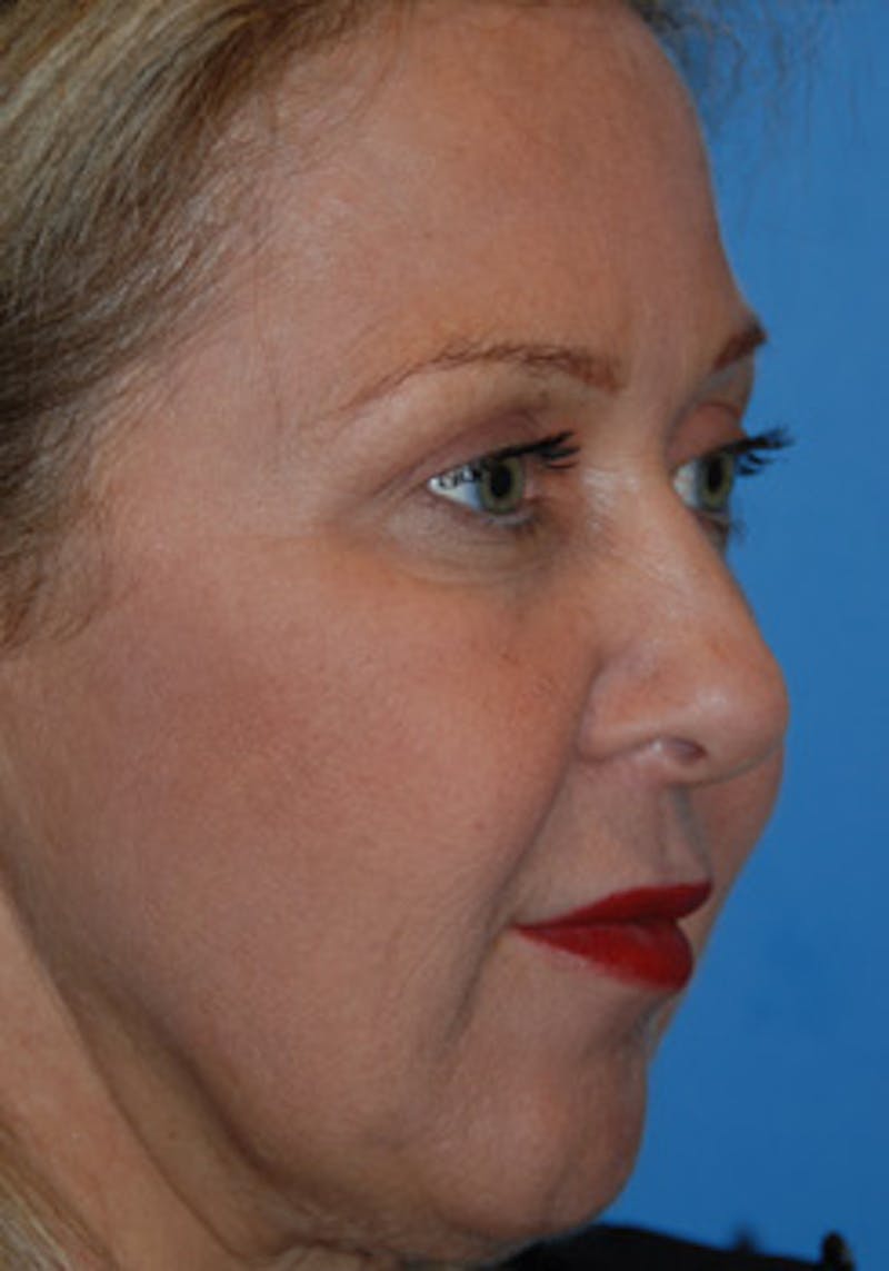 Rhinoplasty Before & After Gallery - Patient 356921 - Image 3