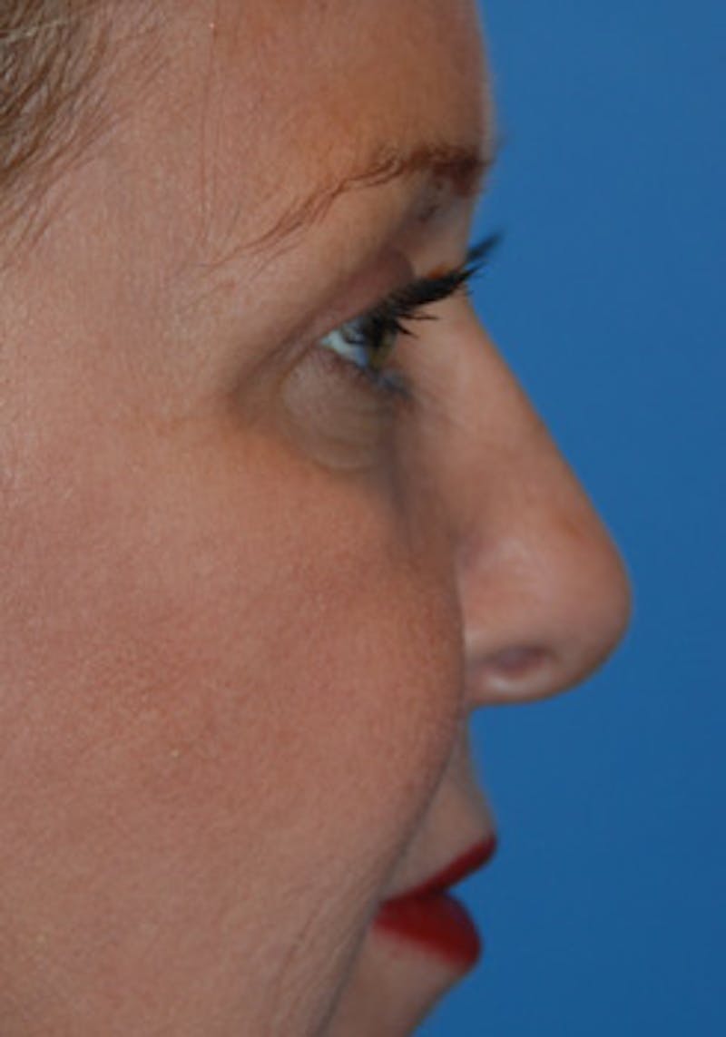 Rhinoplasty Before & After Gallery - Patient 356921 - Image 5