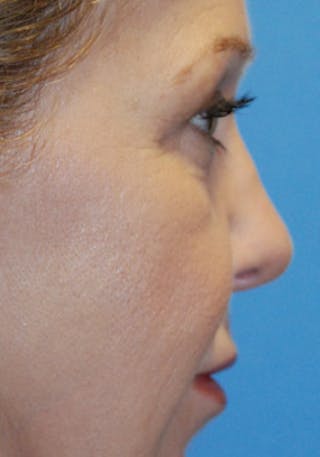 Rhinoplasty Before & After Gallery - Patient 356921 - Image 6