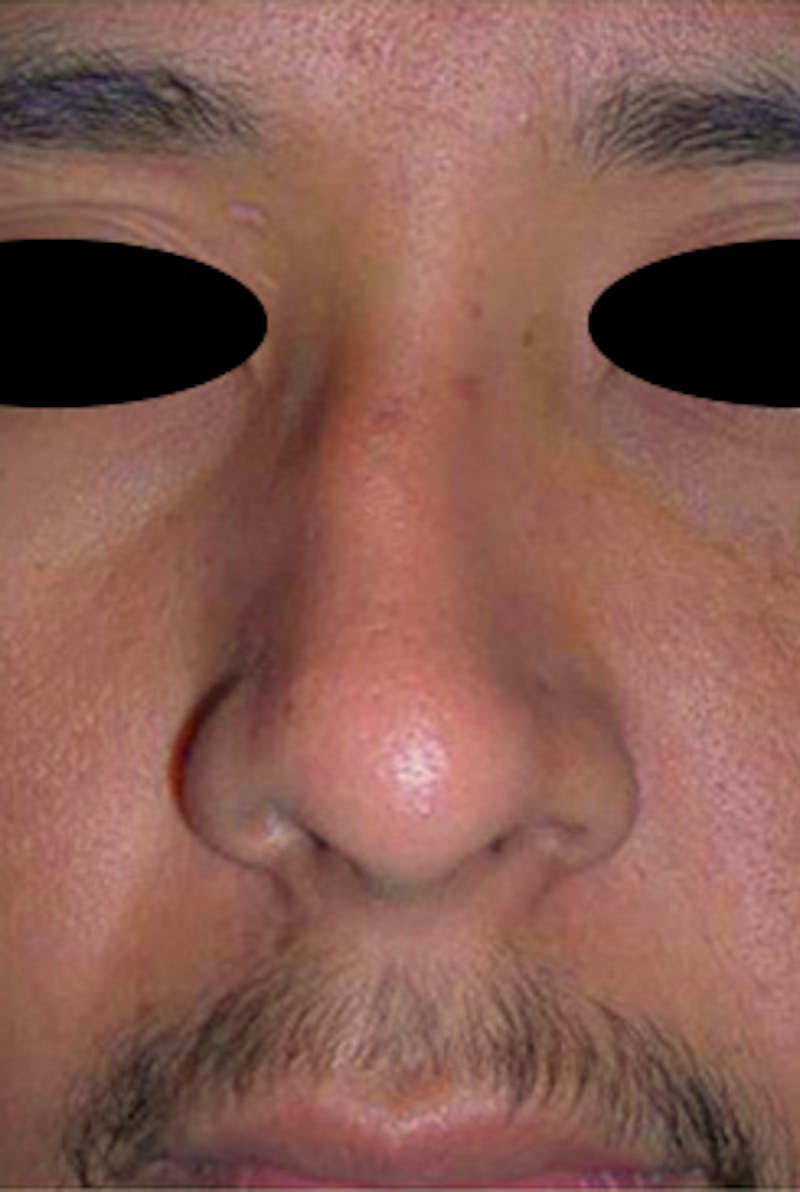 Rhinoplasty Before & After Gallery - Patient 170192 - Image 1