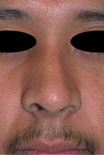 Rhinoplasty Before & After Gallery - Patient 170192 - Image 2
