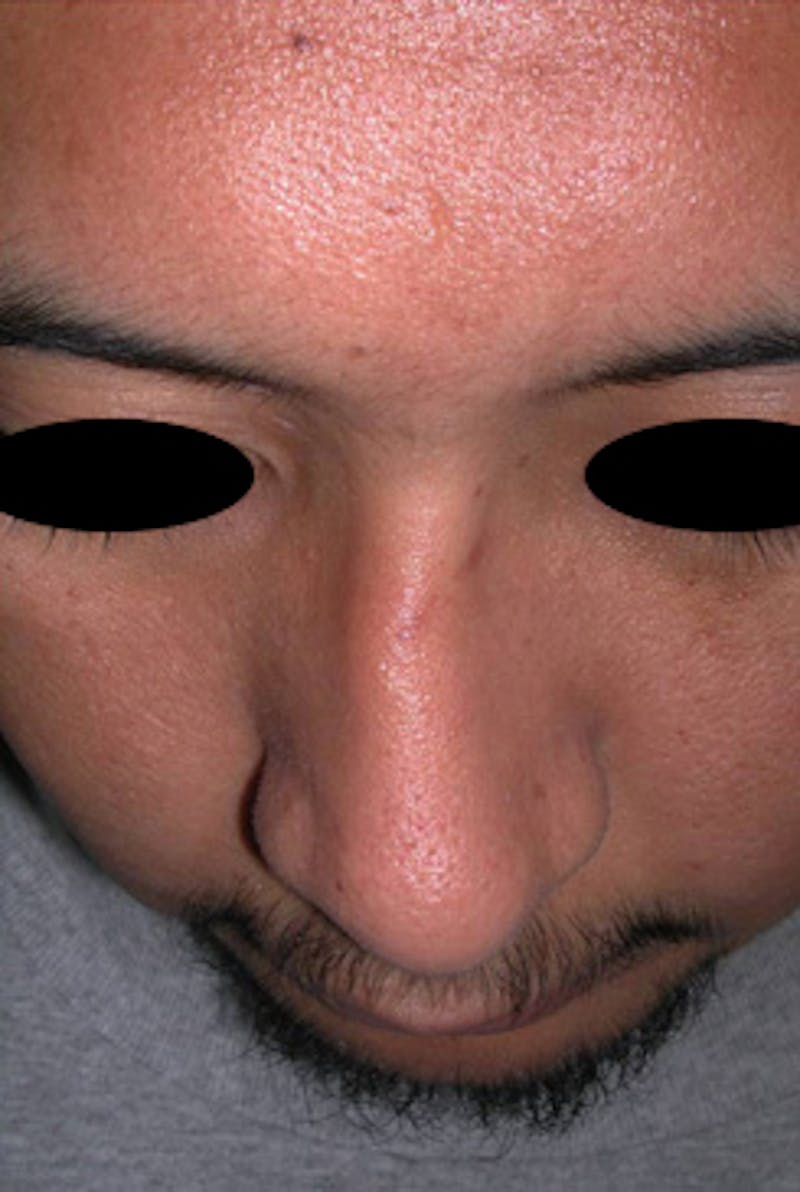 Rhinoplasty Before & After Gallery - Patient 170192 - Image 3