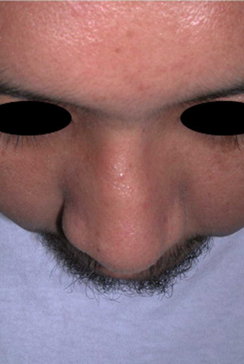 Rhinoplasty Before & After Gallery - Patient 170192 - Image 4