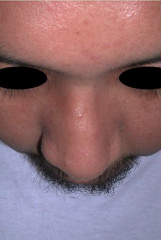 Rhinoplasty Before & After Gallery - Patient 170192 - Image 4