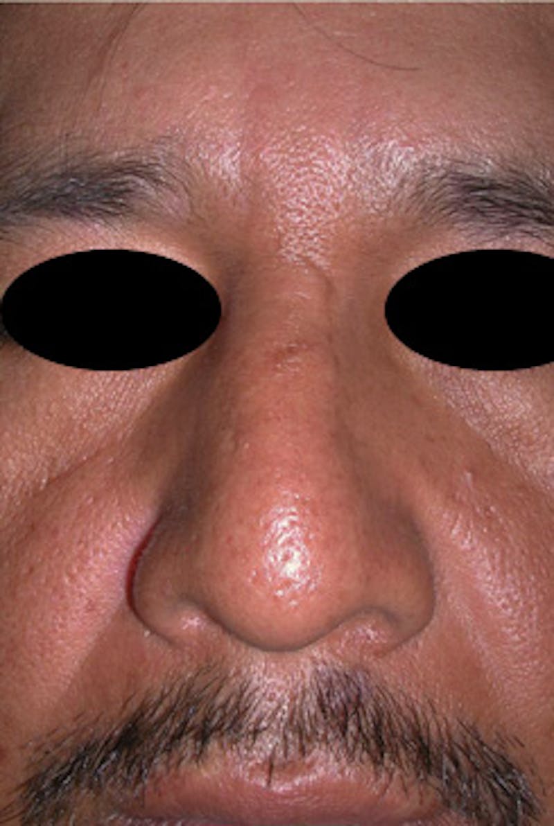 Rhinoplasty Before & After Gallery - Patient 170192 - Image 5