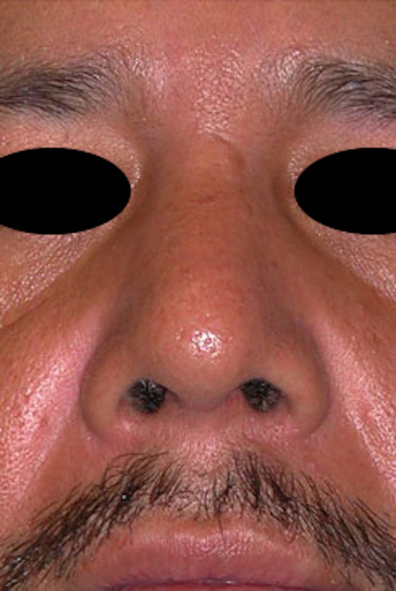 Rhinoplasty Before & After Gallery - Patient 170192 - Image 6