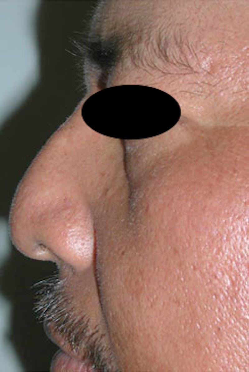 Rhinoplasty Before & After Gallery - Patient 170192 - Image 7