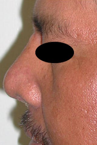 Rhinoplasty Before & After Gallery - Patient 170192 - Image 8
