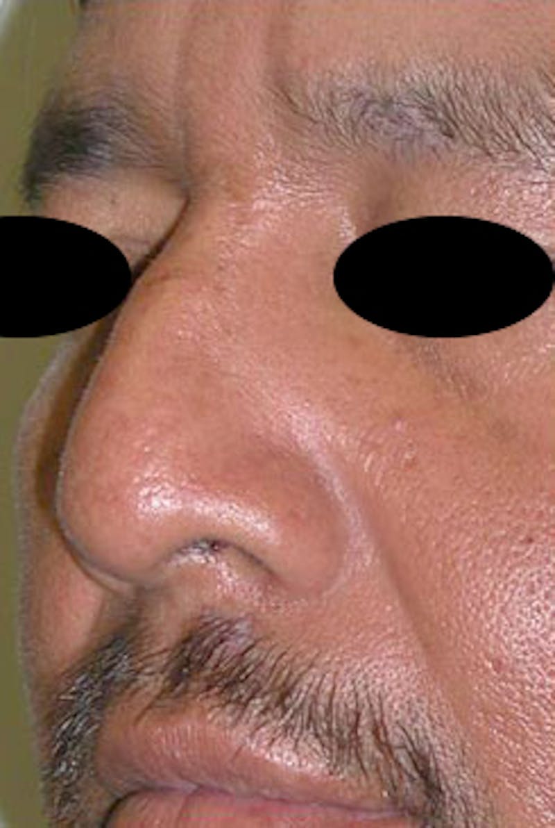 Rhinoplasty Before & After Gallery - Patient 170192 - Image 9