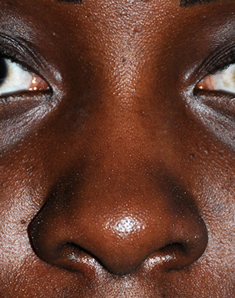 Rhinoplasty Before & After Gallery - Patient 395971 - Image 1