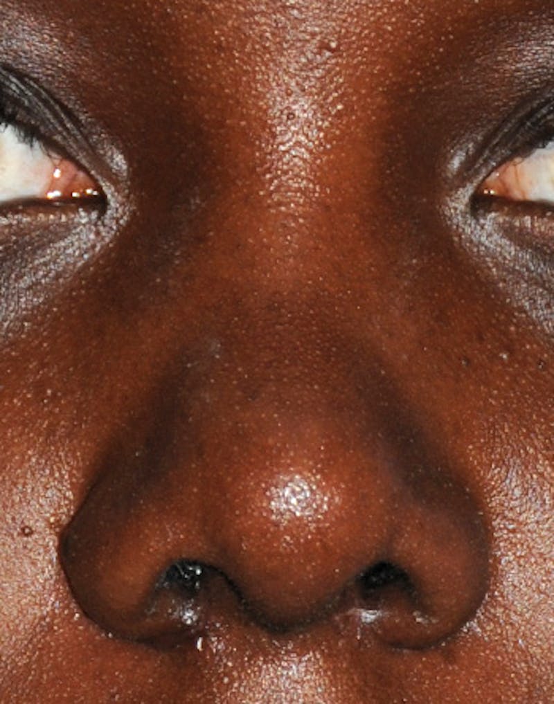 Rhinoplasty Before & After Gallery - Patient 395971 - Image 2