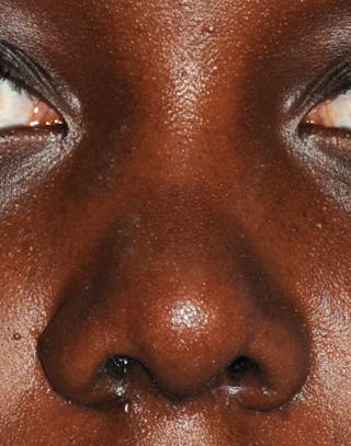 Rhinoplasty Before & After Gallery - Patient 395971 - Image 2