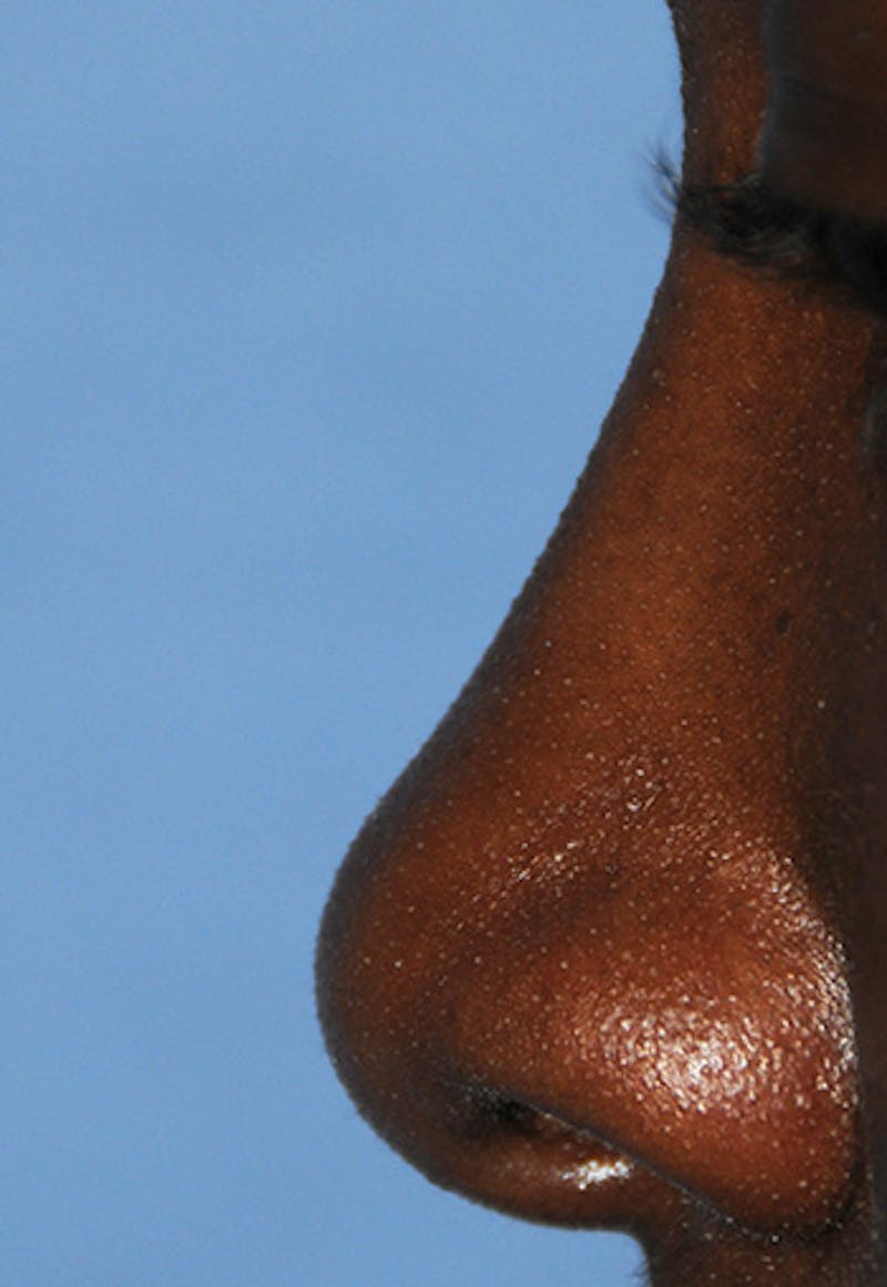 Rhinoplasty Before & After Gallery - Patient 395971 - Image 3