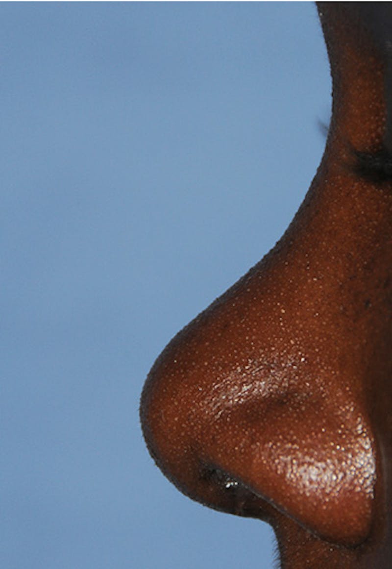 Rhinoplasty Before & After Gallery - Patient 395971 - Image 4