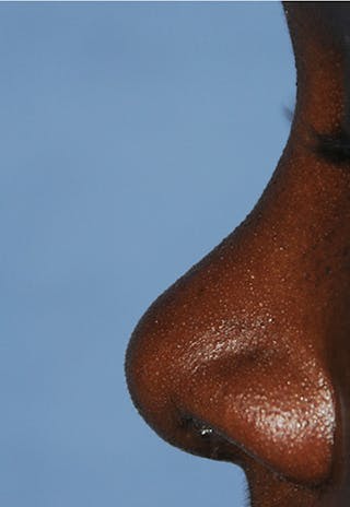 Rhinoplasty Before & After Gallery - Patient 395971 - Image 4