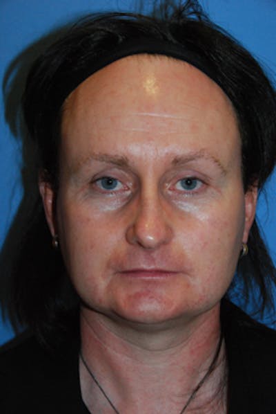 Rhinoplasty Before & After Gallery - Patient 380964 - Image 1