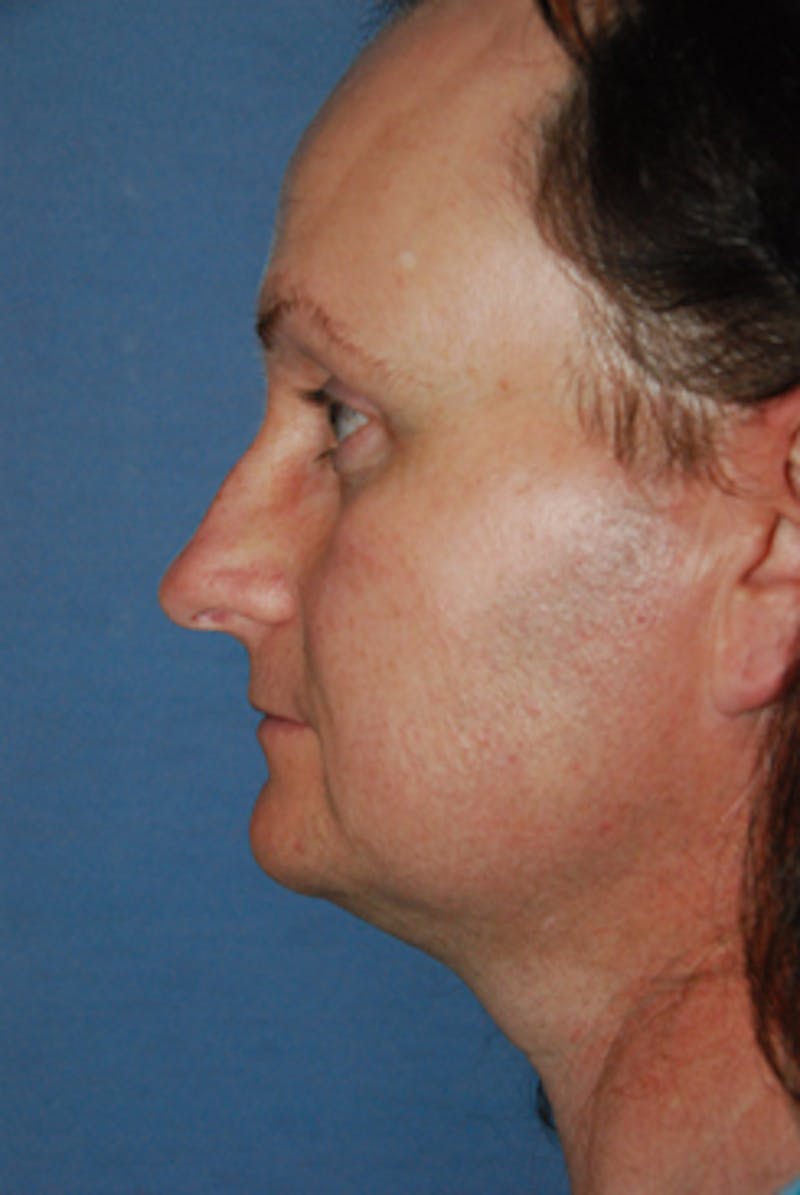 Rhinoplasty Before & After Gallery - Patient 380964 - Image 3