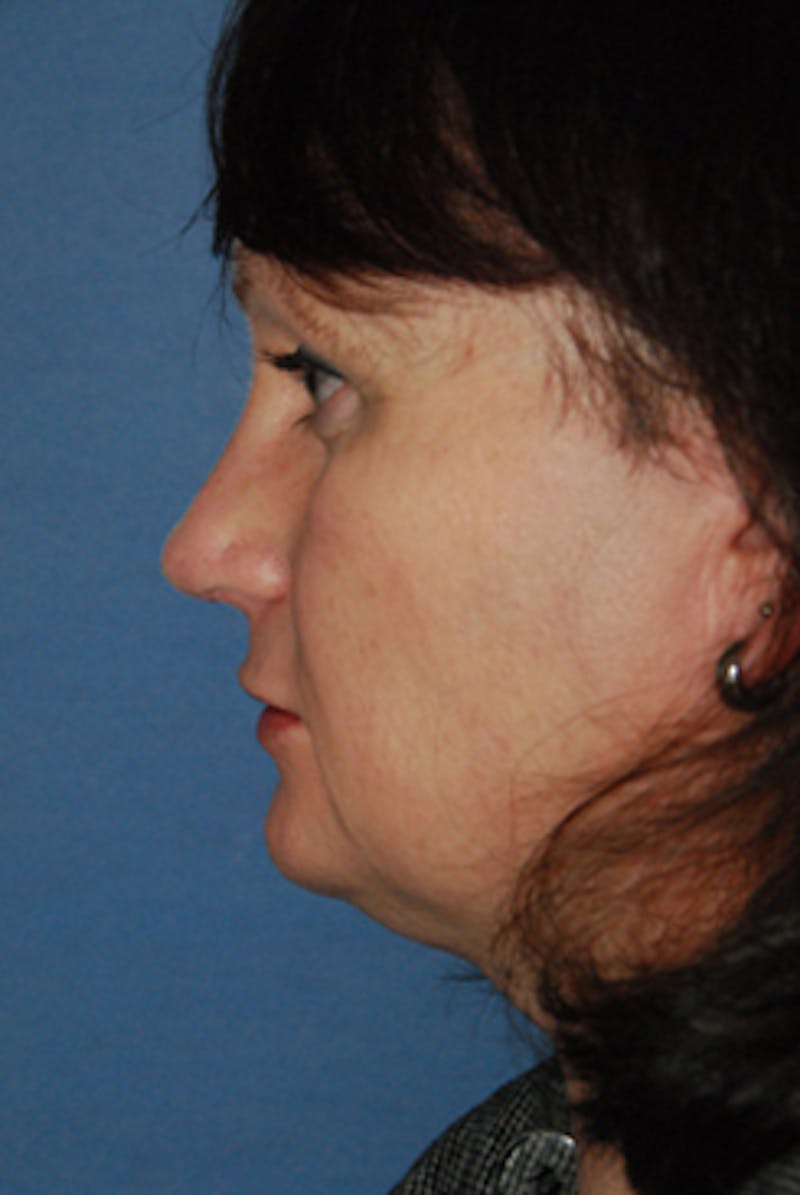 Rhinoplasty Before & After Gallery - Patient 380964 - Image 4