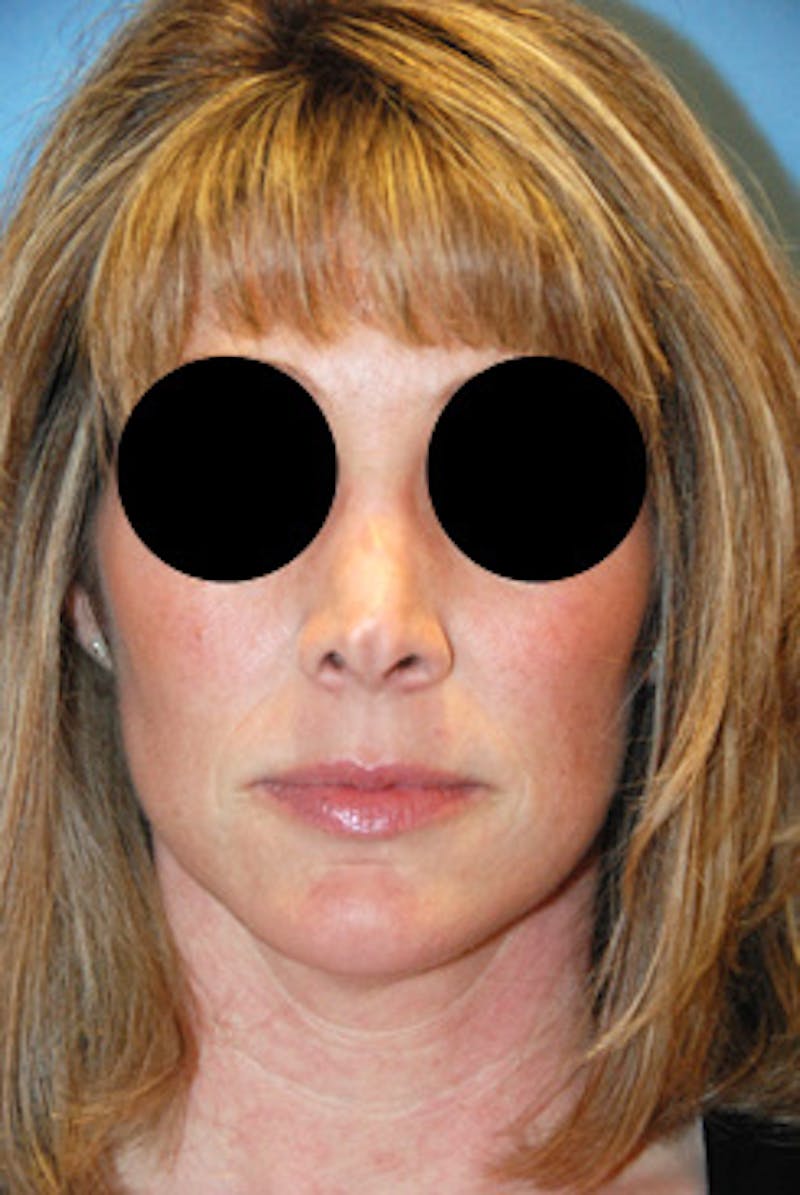 Rhinoplasty Before & After Gallery - Patient 113449 - Image 1