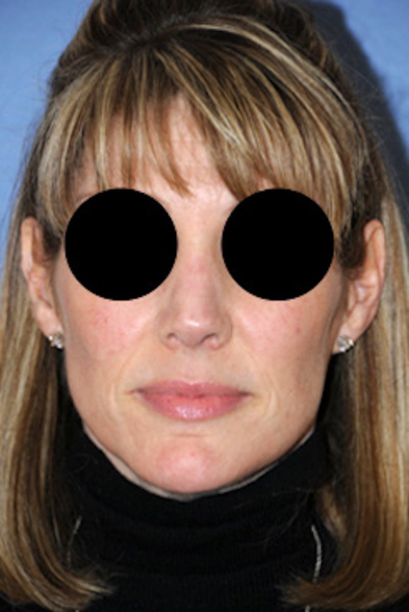 Rhinoplasty Before & After Gallery - Patient 113449 - Image 2