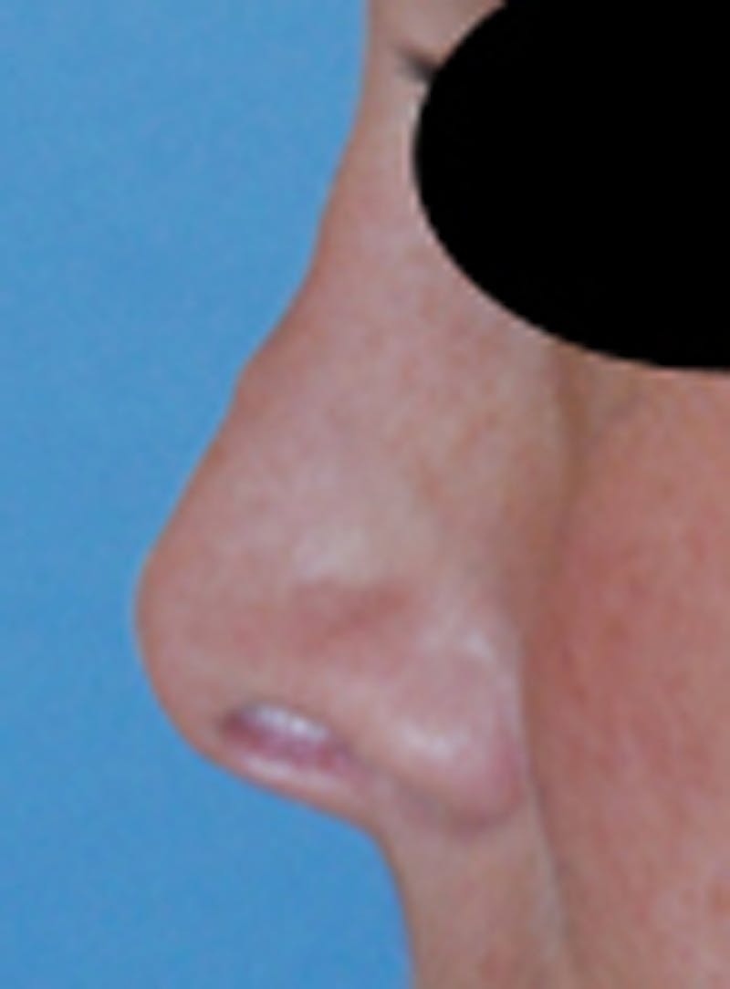 Rhinoplasty Before & After Gallery - Patient 113449 - Image 3