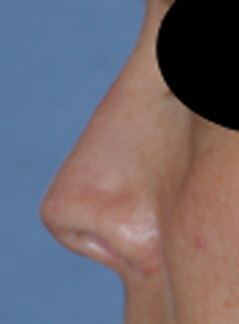 Rhinoplasty Before & After Gallery - Patient 113449 - Image 4
