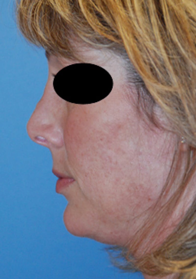 Rhinoplasty Before & After Gallery - Patient 113449 - Image 5
