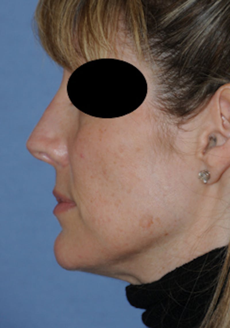 Rhinoplasty Before & After Gallery - Patient 113449 - Image 6