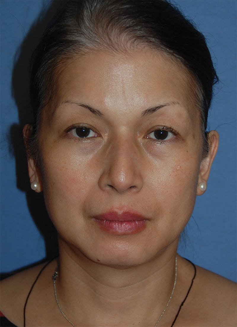 Rhinoplasty Before & After Gallery - Patient 902257 - Image 1