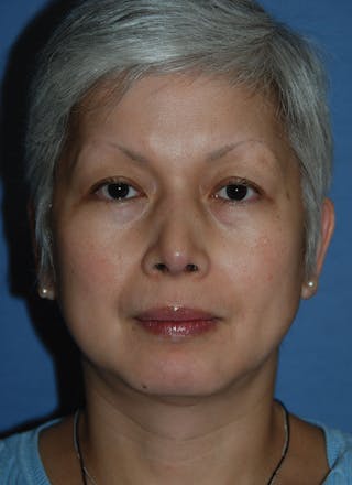 Rhinoplasty Before & After Gallery - Patient 902257 - Image 2