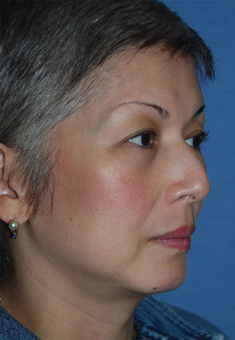 Rhinoplasty Before & After Gallery - Patient 902257 - Image 3
