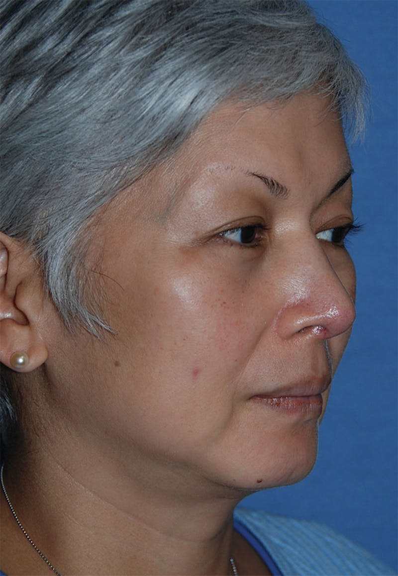 Rhinoplasty Before & After Gallery - Patient 902257 - Image 4