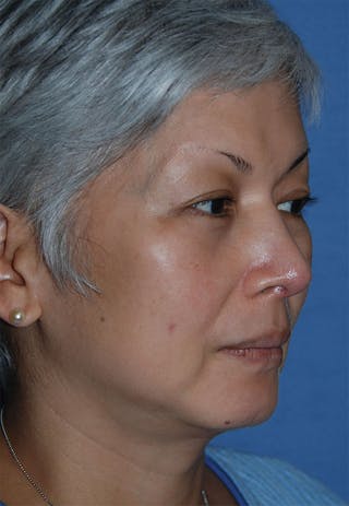 Rhinoplasty Before & After Gallery - Patient 902257 - Image 4