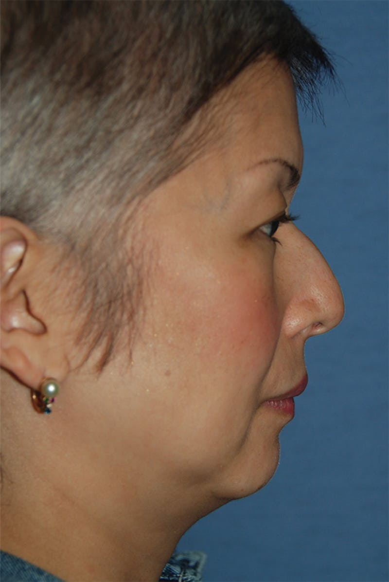 Rhinoplasty Before & After Gallery - Patient 902257 - Image 5