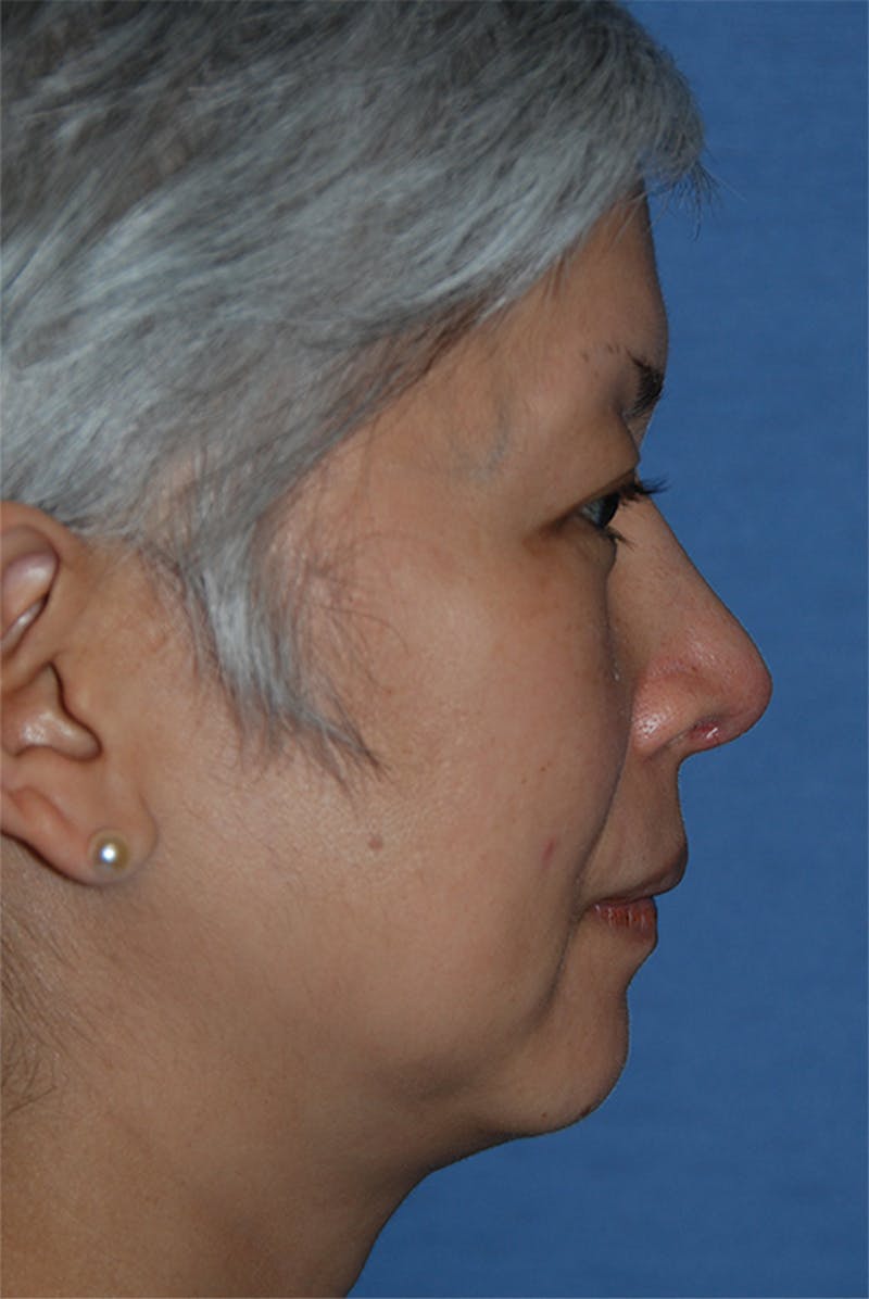 Rhinoplasty Before & After Gallery - Patient 902257 - Image 6