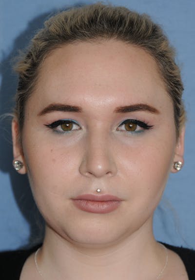 Rhinoplasty Before & After Gallery - Patient 327405 - Image 1