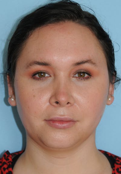 Rhinoplasty Before & After Gallery - Patient 327405 - Image 2