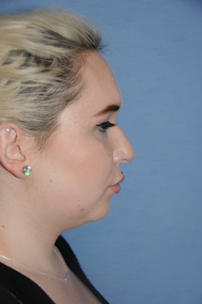 Rhinoplasty Before & After Gallery - Patient 327405 - Image 3