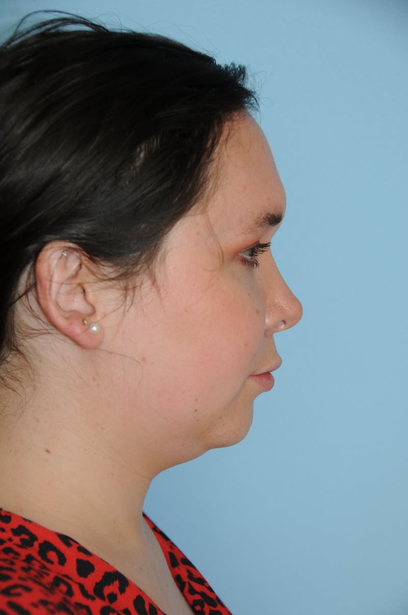 Rhinoplasty Before & After Gallery - Patient 327405 - Image 4