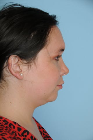 Rhinoplasty Before & After Gallery - Patient 327405 - Image 4