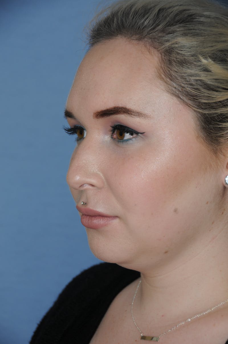 Rhinoplasty Before & After Gallery - Patient 327405 - Image 5