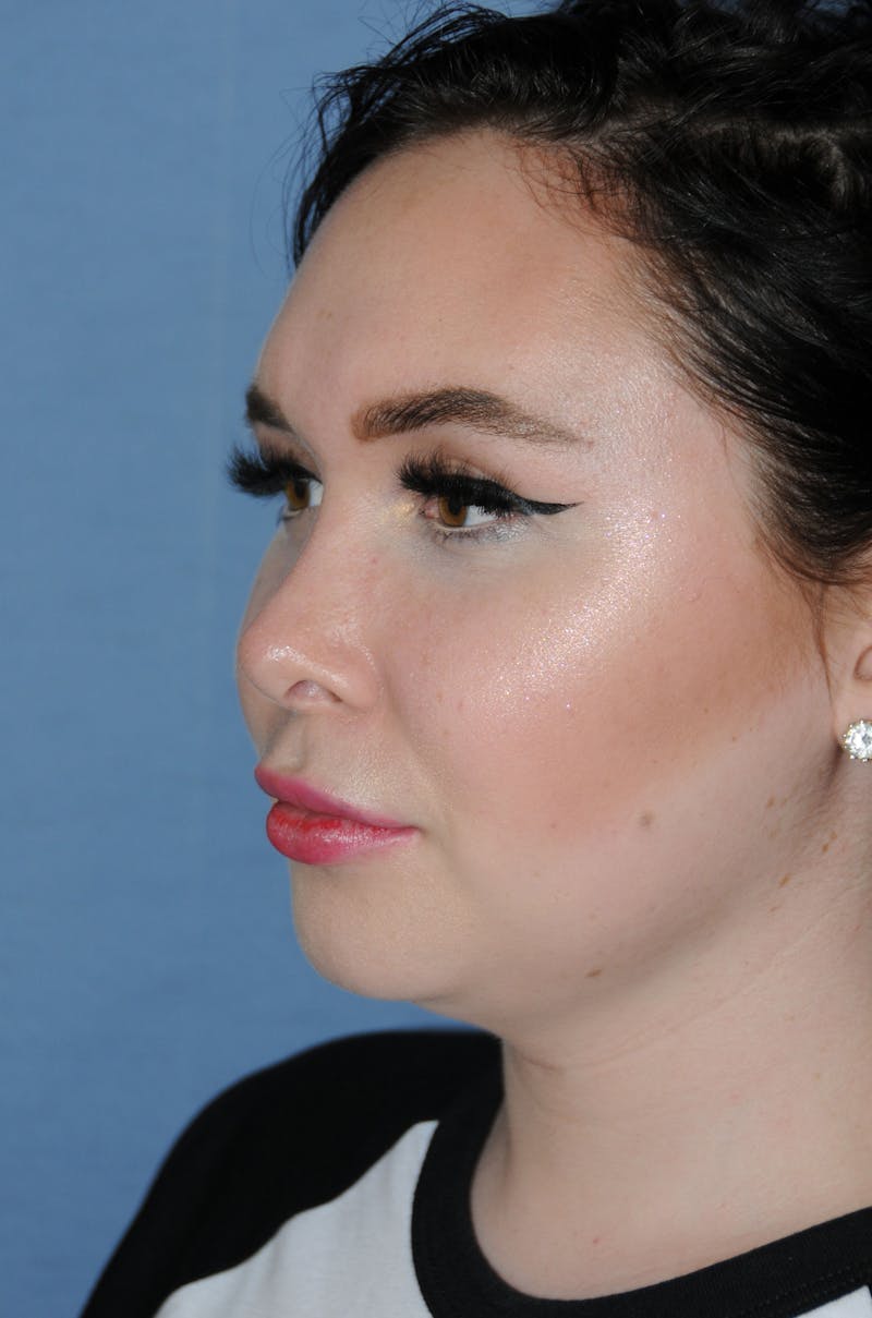 Rhinoplasty Before & After Gallery - Patient 327405 - Image 6